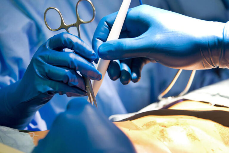 A Summary Of Gynecomastia Surgeon