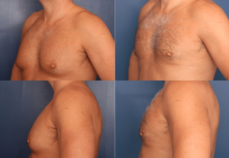 Gynecomastia Surgery - An Introduction