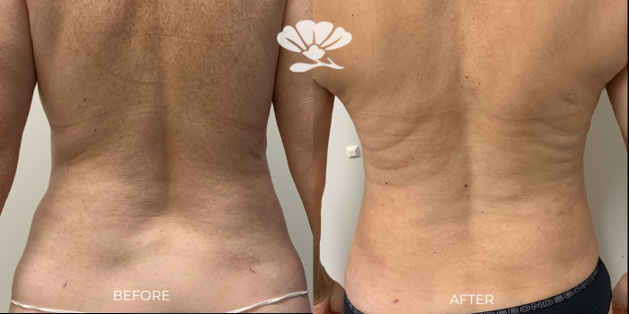 Precise Analysis On The Liposuction Near Me