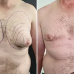 gynecomastia