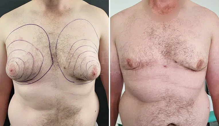 gynecomastia